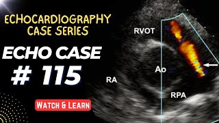 ECHO CASE 115  Echocardiography Spot Diagnosis Case Series [upl. by Mclaughlin]