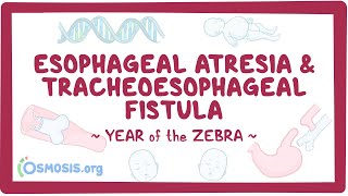 Esophageal atresia amp tracheoesophageal fistula Year of the Zebra [upl. by Tana]