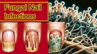 Understanding Onychomycosis Nail Fungal Infection Treatment [upl. by Venuti596]