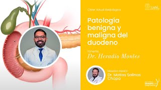 Patología benigna y maligna del duodeno por el Dr Heradio Montes [upl. by Enirahtac]