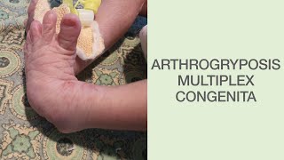 Arthrogryposis multiplex congenitanewborn multiple joint contracture [upl. by Yusuk]