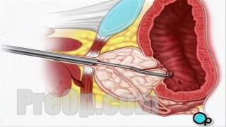 TURP Transurethral Resection Prostate Surgery patient education series [upl. by Len88]