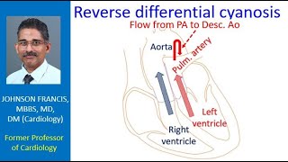 Reverse differential cyanosis [upl. by Corb]