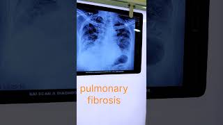 pulmonary fibrosis x ray quot medicine point by Dr Sunil singh [upl. by Nicolette]