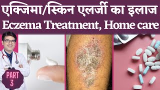 Eczema Treatment In Hindi  एक्ज़ेमा का इलाज  Skin Allergy Dermatitis Treatment  Dermatologist [upl. by Notsniw593]