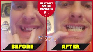 Jonathon Review  Instant Smile Veneers Customer Review 2024 [upl. by Amoihc]