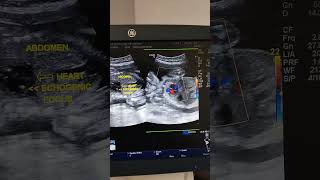 Fetal Echogenic Intracardiac Focus Ultrasound [upl. by Jessalyn]