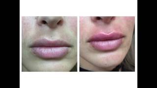 Juvederm Lips by Anusha in West LA [upl. by Bouchier]