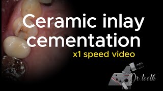 Ceramic inlay cementation procedure X1 speed 세라믹 인레이 세팅 과정 [upl. by Reena587]