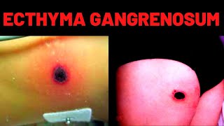 WHAT IS ECTHYMA GANGRENOSUM Causes Symptoms [upl. by Petronille]