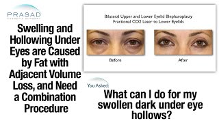 How Excess Fat Under the Eyes Causes Eye Bags but Losing Fat in Adjacent Areas Causes Hollowness [upl. by Asilla]