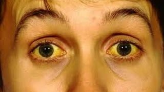 Yellow Skin  Symptoms and Treatment  Jaundice   Segment 2  Health First [upl. by Ilrahc]