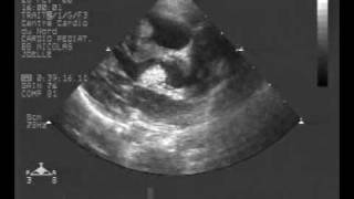 echocardiogram multiple rhabdomyoma tumorLong axis view [upl. by Natala]