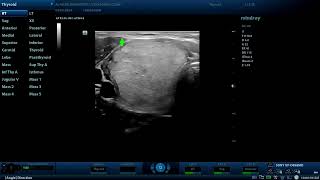 4th tirads score thyroid nodule Diagnostic ultrasound cases [upl. by Lanahtan701]