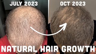 Regrow Your Hair Naturally No Finasteride No Minoxidil [upl. by Sordnaxela]