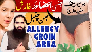 Jinsi Aza Ki Kharish Allergy Aur Uska Homeopathic Ilaj  Rash amp Eczema Treatment Naturallyquot [upl. by Thora741]