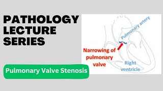 Pulmonary Valve Stenosis  Pathology Lecture Series  Lecture 17 [upl. by Gwendolyn]