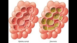 Neumonia  Fisiopatológia  Cuadro Clinico [upl. by Asilec]