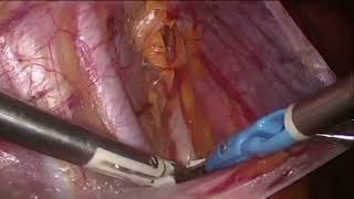 Laparoscopic Removal of a Giant Ovarian Cyst [upl. by Alled]