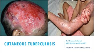 SKINCUTANEOUS TUBERCULOSIS BY DR ABRAHAM TB ulcers funny viralvideo education dermatology [upl. by Adnilrev673]