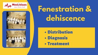 Fenestration and Dehiscence l Periodontal anatomy l Mediklaas [upl. by Inus373]