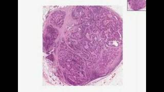 Histopathology Lymph node Adenocarcinoma metastatic to ly [upl. by Truk]