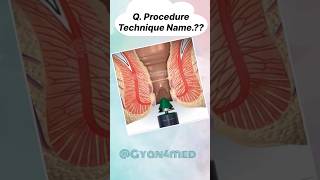 Procedure technique name [upl. by Shandy]