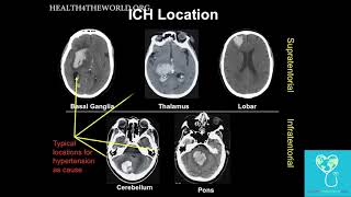 Intracerebral Hemorrhage Part 2  Health4TheWorld Academy [upl. by Elsa]