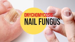 🦶 Get rid of Nail Fungus  Onychomycosis with these 13 Natural Remedies [upl. by Cad]