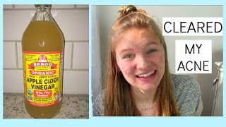 APPLE CIDER VINEGAR CLEARED MY ACNE  Grace Jennings [upl. by Anak]