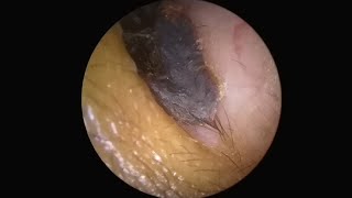 AMAZING EAR STONE REMOVAL YOU HAVE TO SEE THIS [upl. by Nnayhs]