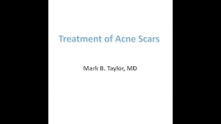 Acne Scar Subcision  Smooth pitted acne scars with Taylor Liberator CO2 laser [upl. by Chu]