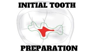 Mesio Occlusal Class 2 Initial Tooth Preparation  Proximal Outline Form [upl. by Nywnorb501]