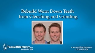 Rebuild Worn Down Teeth from Clenching and Grinding [upl. by Barnabe926]