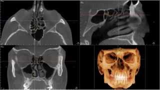 CBCT Interpretation Paranasal Sinuses Movie Sneak Peak [upl. by Yrellih]