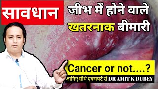 Tounge ulcer ।। Tounge back side ulcer।। Tounge papilitis ।।Tounge Infaction Treatment dramitkdubey [upl. by Eninej]