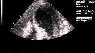 Transthoracic Echocardiogram Showing Akinesis on Apical FourChamber View [upl. by Terrance629]