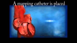 Ventricular Tachycardia VT Ablation [upl. by Bouchier]