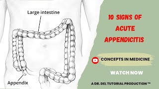 10 Signs Of Acute Appendicitis Made So Easy [upl. by Weinreb]