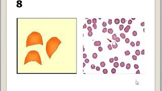CLASE 2 ANORMALIDADES ERITROCITARIAS [upl. by Irb]