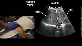 Transverse Liver Scan Technique [upl. by Ellerret853]