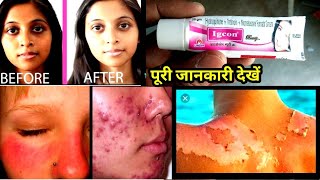 igcon beauty cream uses or side effects in hindi [upl. by Esiouqrut]