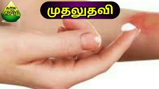 சமைக்கும் போது தீ சுட்ருச்சா  First aid for skin burn in tamil  treatment for minor burns in tamil [upl. by Shirberg]