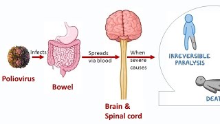 Poliomyelitis medicalsurgicalnursing 2gnm 2nd Gnm [upl. by Nnylatsyrc]