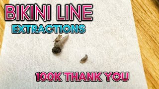 100k‼️ How to Get Rid of Ingrown Hairs on Bikini Line Expert Tips and Techniques for Smooth Skin [upl. by Efioa]