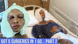 I GOT A FACELIFT IN MY 20’S   4 Other procedures  Recovery  Results Pt 2 [upl. by Helbonnah]