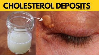 Fastest Way To Get Rid Of Xanthelasma  Squeeze Out Cholesterol Deposits Around Your Eyes [upl. by Chelton]