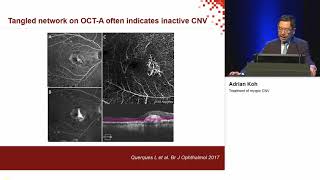 Treatment of myopic CNV Koh Adrian [upl. by Reniti]