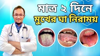 মুখের ঘা দূর করার উপায়mukhe gha hole ki korboমুখে ঘা হলে কি করবেনমুখের ঘা সারানোর উপায় [upl. by Aerdnahs320]