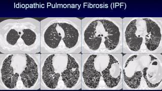 CHEST 2016 video sessions HRCT of the chest [upl. by Blithe553]